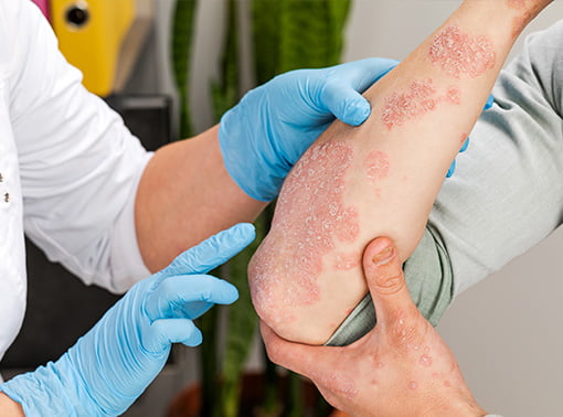 dermatita-de-contact-iritanta